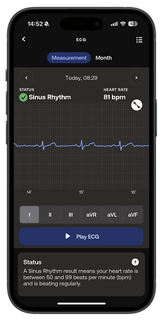 An ECG reading showing sinus rhythm with a heart rate of 81 bpm on a mobile device.